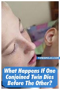 What happens if one conjoined twin dies before the other? - TimesMojo