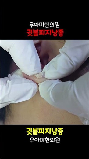귓볼 멍울은 어떻게 제거해야 할까요?(귀 피지낭종 귓볼 피지낭종 표피낭종 압출 제거 주머니 재발)