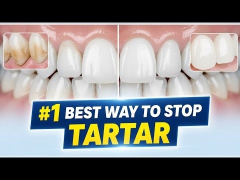 #1 Absolute Best Way to Stop Tartar FAST!Dentists Hate How Simple This Tartar Trick Is!Remove Tarta