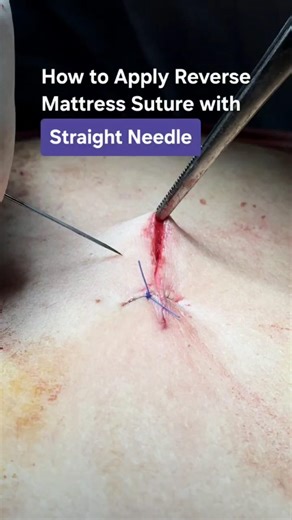 How to Apply Reverse Mattress Suture with Straight Needle ‪@Tayyabriazch‬