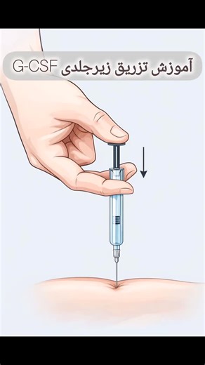 ‎دکتر بابک شازاد | خون و انکولوژی‎ on Instagram‎: "بعد از شیمی‌درمانی، تزریق G-CSF به بدن کمک می‌کند دوباره گلبول سفید بسازد و خطر عفونت را کاهش دهد. در این ویدیو، نحوه صحیح تزریق زیرجلدی را به صورت مرحله‌به‌مرحله نشان داده‌ایم: محل مناسب تزریق زاویه صحیح سوزن نکات ایمنی برای بیمار #آموزش_بیمار #شیمی_درمانی #GCSF #تزریق_زیرجلدی #دکتر_بابک_شازاد"‎