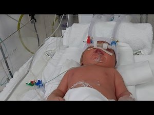 Non invasive ventilation, NIV, spontaneous CPAP, after INSURE technique ,RDS, IDM