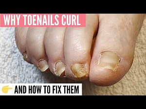 Why Toenails Curl 👉 AND How To Fix Them Tiny Ram's Horn Toenails Reversal