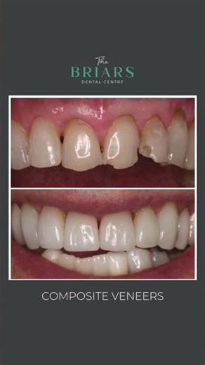 Before and After Composite Veneers