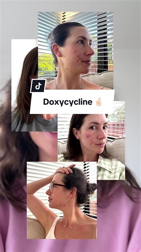 Doxycycline Journey for Adult Acne: Share Your Experience