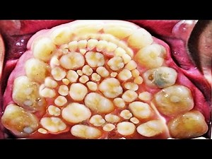 2016 World Record for Most Teeth & Hyperdontia!