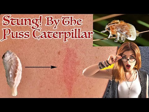 STUNG! By the PUSS CATERPILLAR in North Carolina - United States Most Venomous Caterpillar!*