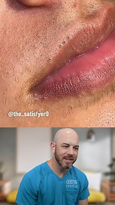 These lip blackhead POPS are all the rage! (credit: @the_satisfyer on TT) #skincare #blackheads | Dr. Dustin Portela, Dermatologist
