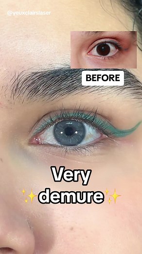 Natural Laser Eye Color Change: Before & After Transformation