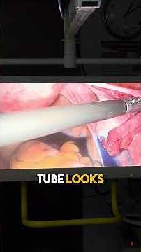 Diagnostic Laparoscopy