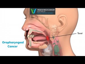Oropharyngeal Cancer - What Is It? Symptoms and Treatment? Head and Neck Cancer