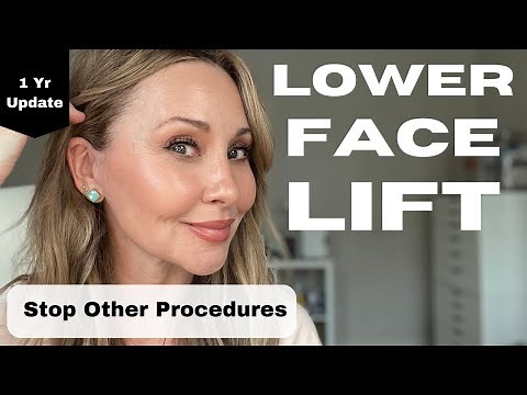 Lower Facelift: My 1 Year Review (lets get real)
