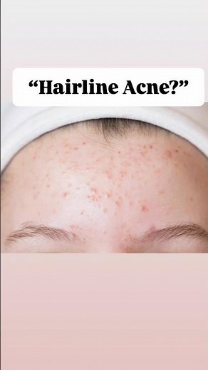 Forehead Bumps? This Is Why You’re Getting Them! 😳 | Hairline Acne Fix|#skincare #shorts