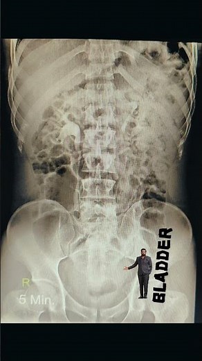 IVP PROCEDURE Both renal normal excretion