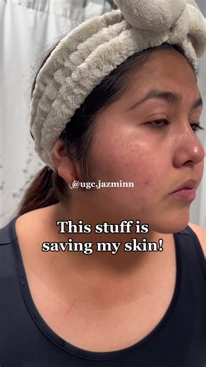 Neutrogena On-the-Spot Acne Treatment Review