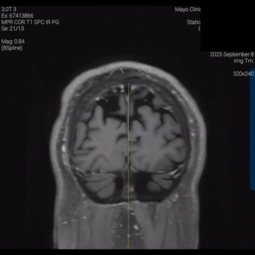 Cerebellar Atrophy MRI