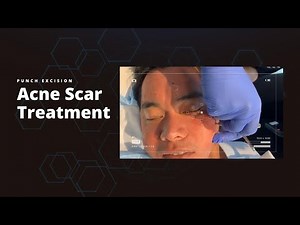 Punch Excision | Acne Scar Treatment | West Hollywood, CA | Dr. Jason Emer