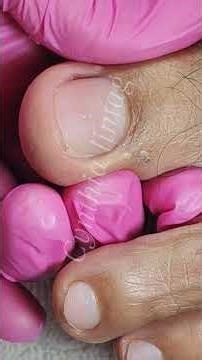 how to remove ingrown #nails #nailcare #pedicure