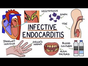 Understanding Infective Endocarditis