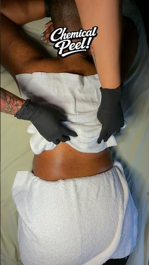 Intimate hyperpigmentation correction. Dark marks inner thighs, underarms, bikini, and back!