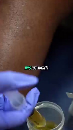 1K views · 33 reactions | Knee aspiration, or arthrocentesis,...