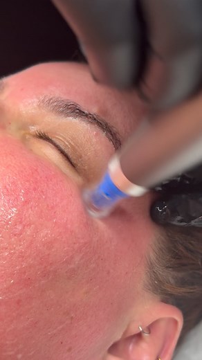 4 comments | ✨ Now Launching: Microneedling + DMK Enzyme Therapy ✨...