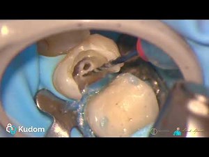R One Mini in a narrow and calcified upper first premolar