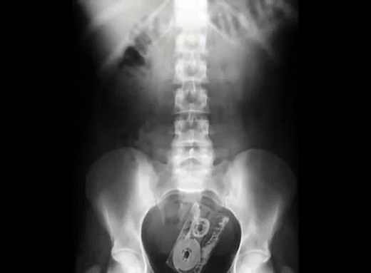 【女子ショック】レントゲン写真(Ｘ線写真)で女性器(ま こ)が写っている件［衝撃の事実］