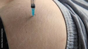 Needle injecting into the muscle. Nurse doing a trigger point injection in patient back. Close up doctor makes an shot therapy. Alternative pain treatment. Covid-19, pox, MPOX, flu virus vaccine. Stock Video
