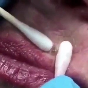 21K views · 59 reactions | Pimple Popper Tools:...