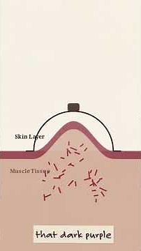The Truth About Cupping Marks Revealed! 🩸