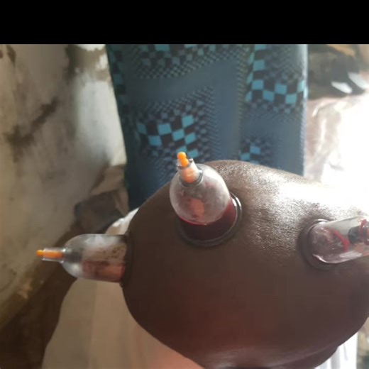 Hijama (wet cupping therapy) is traditionally used in many cultures for headache and migraine relief. Some people report feeling better after hijama, especially when migraines are frequent and stubborn. Here are the commonly claimed benefits of hijama for migraine: 1. May reduce head pressure Hijama on the head, neck, and upper back is believed to help reduce pressure and tension that can trigger migraine pain. 2. Improves blood circulation Cupping increases blood flow to the area, which may hel