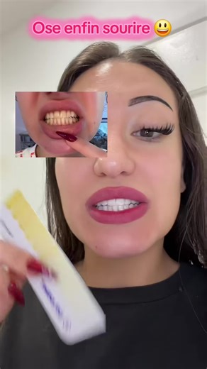 Blanchiment dentaire à la maison ✅️