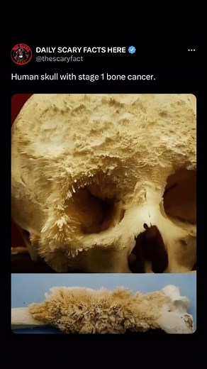The image shows a human skull and bone with abnormal growths consistent with bone cancer. In the context of bone cancer, such as osteosarcoma or other malignant bone tumors, these growths represent areas where cancerous cells are proliferating, causing the bone to become irregular and porous. In Stage 1 bone cancer, the tumor is typically localized and has not yet spread to other parts of the body. Treatment at this stage usually involves surgery to remove the tumor, potentially combined with ch