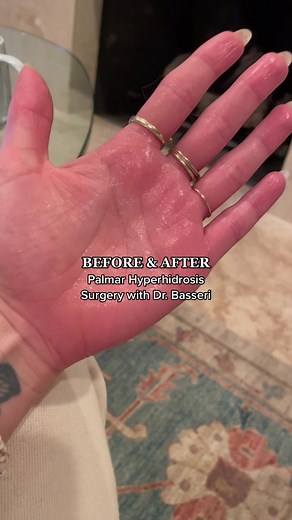 Palmar Hyperhidrosis Surgery Before vs After | Excessive Sweating Relief
