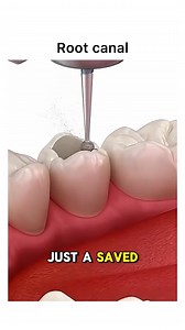 18K views · 77 reactions | #rootcanal #rootcanaltreatment #worlddentalassociation | World Dental Association | Facebook