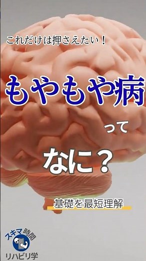 【基礎】もやもや病ってなに？PTなら知っておきたい基礎 #理学療法士国家試験 #理学療法士 #作業療法士国家試験 #作業療法士 #基礎 #脳 #脳出血 #脳卒中 #脳動脈 #もやもや病