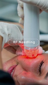 2K views · 7 comments | RF needling, also known as Radiofrequency...