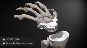 Wrist Replacement Procedure - 3D medical animation