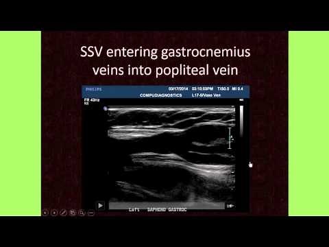 The Importance of Venous Anatomy for the Reflux Ultrasound Examination