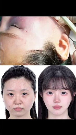 #ImprovedNasolabialFolds #FaceLift #Wrinkles #ImprovedEfficiency #AppleCheeks #AntiAging #Facelifts