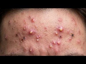 Loan Nguyen Acne Treatment 9jj