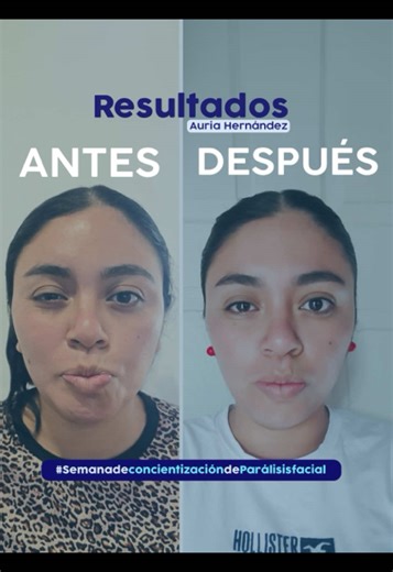 Concientización sobre Parálisis Facial en Chiapas