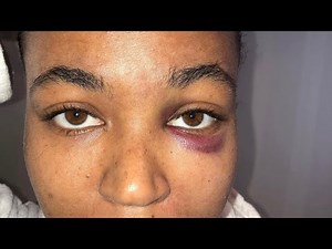 Ashanti’s sister Kenashia Douglas gets her teeth knocked out by rapper slowbucks #domesticviolence