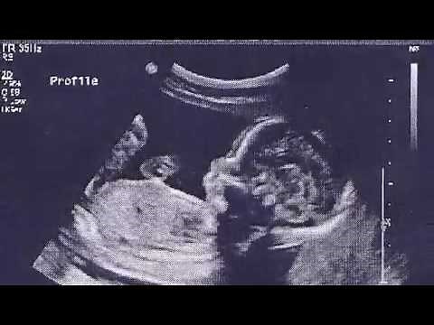 Ultrasound 20 Weeks 5 Months Pregnant Is it a Boy or a Girl?