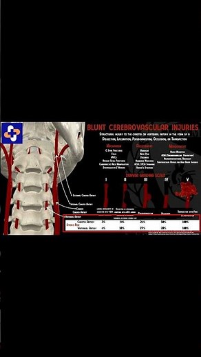 🚑 Blunt Cerebrovascular Injury (BCVI) Explained #trauma #EMS #emergencymedicine #neurosurgery
