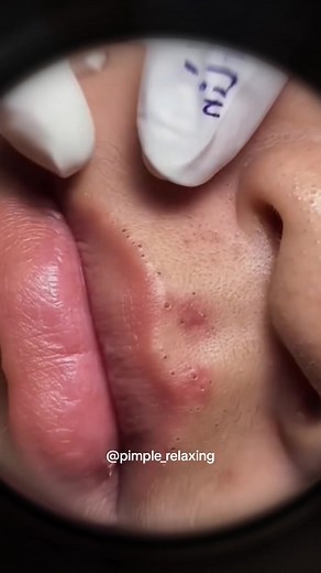 Pimple Popping Extractions | Super Satisfying Blackhead Removal