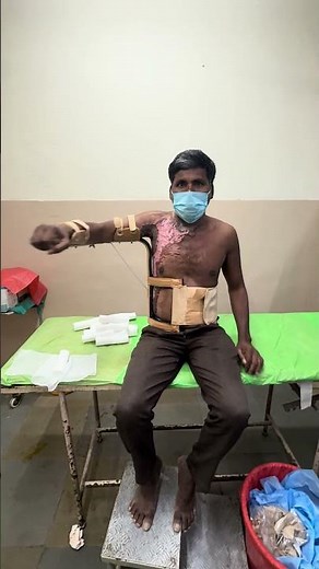 How an ideal aeroplane splint should be applied and work in a post burn Axilla contracture release