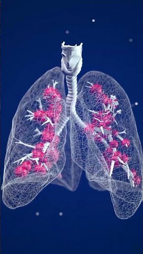 What is Pneumonia?