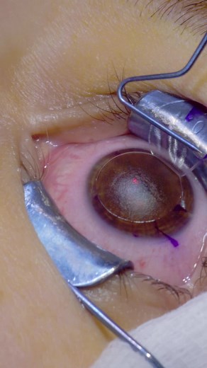 Cirurgia Refrativa: Adeus Miopia com LASIK